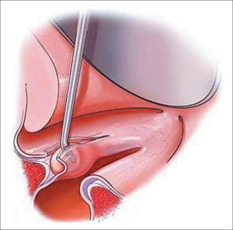 Best micro laryngeal surgeon in Allahabad